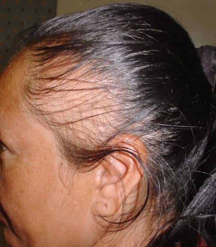 scarring alopecia treatment