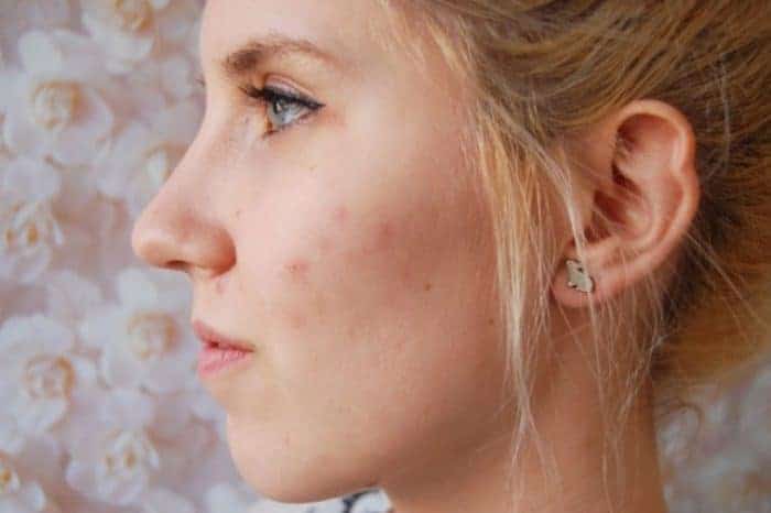 How To Remove Pimple Scars Naturally SheIdeas