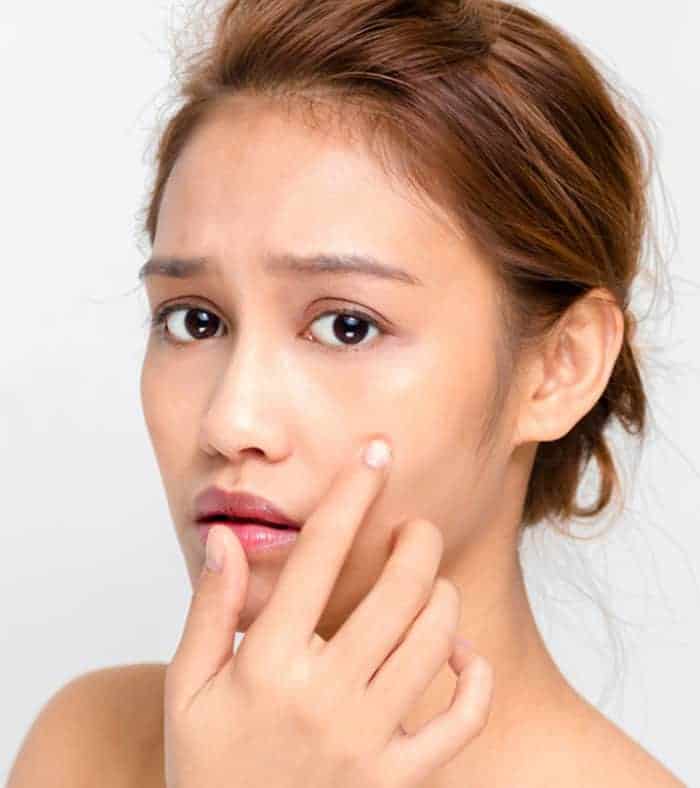 How To Clear Acne Marks Naturally Fast