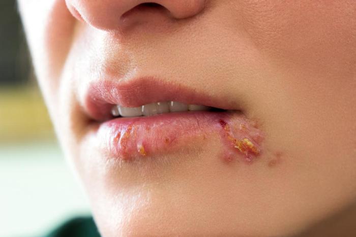 herpes on lips